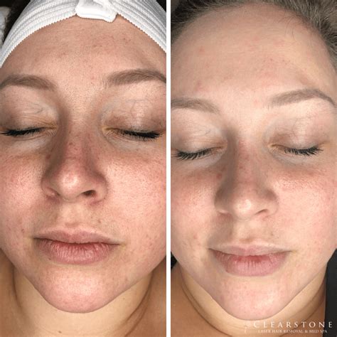 dermaplaning ruined my skin|breaking out after dermaplaning.